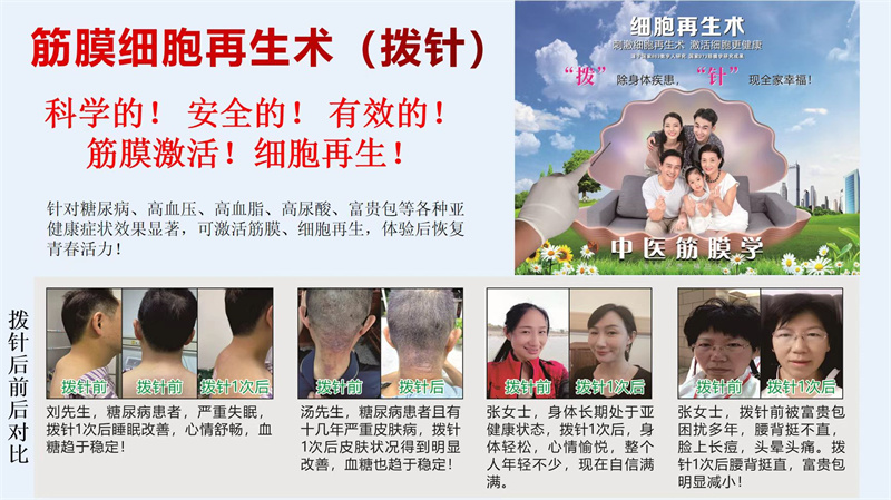 中医科筋膜细胞再生术